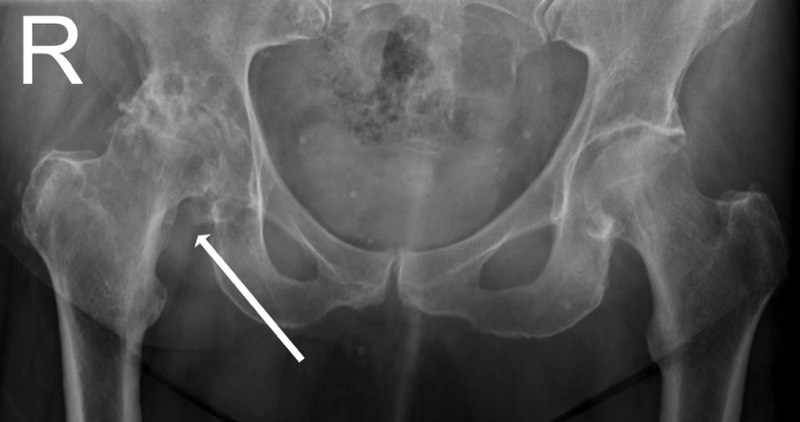 Osteoarthritis of the right hip
