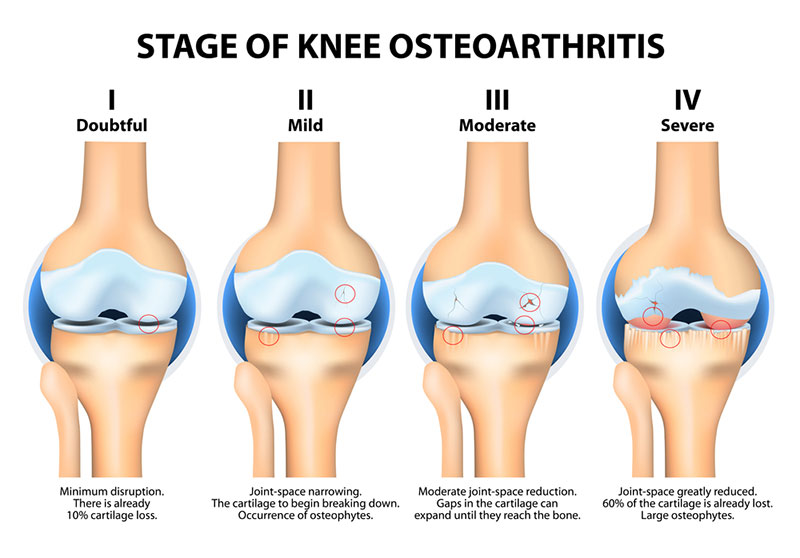 Knee Osteoarthritis | OASIS Orthopaedics Melbourne