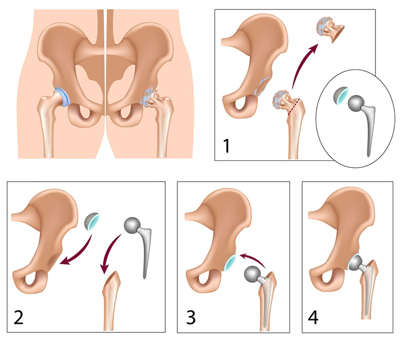 Total Hip Replacement Melbourne